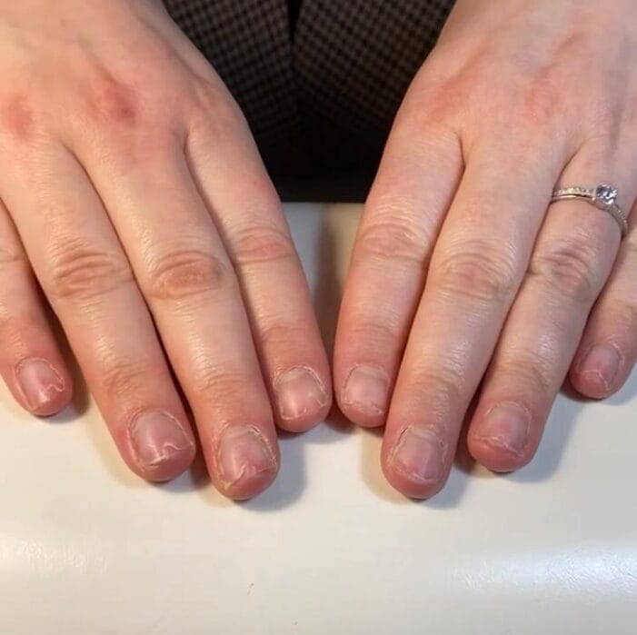 reconstruction des ongles rongés